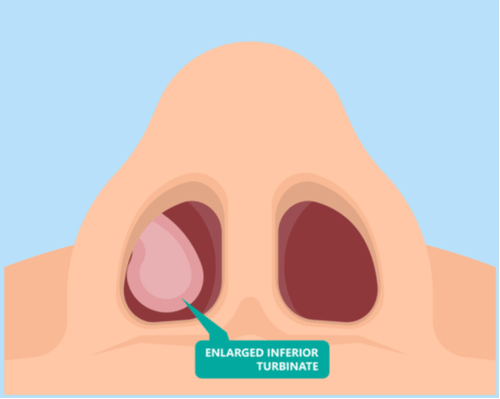 Tip-Rhinoplasty-Dr-Kleid-Melbourne