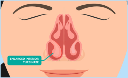Tip-Rhinoplasty-Dr-Kleid-Melbourne