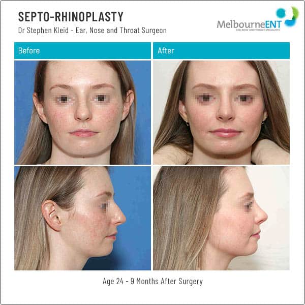 Age 24 - 9 Months After Surgery