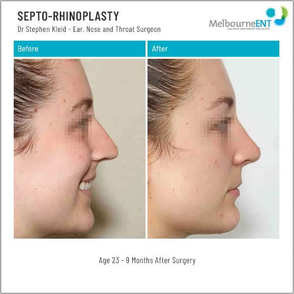 Age 23 - 9 Months After Surgery