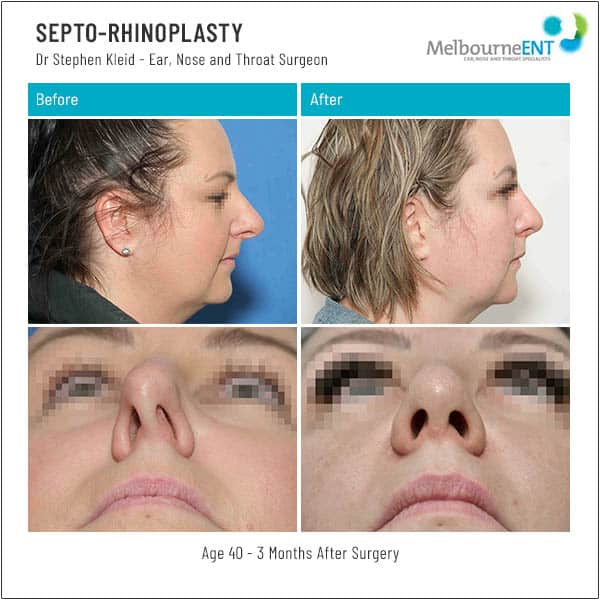Age 40 - 3 Months After Surgery