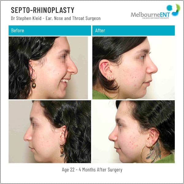 Age 22 - 4 Months After Surgery
