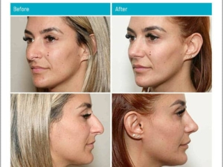 Age 32, 9 Months after Surgery Age 32, 9 Months after Surgery