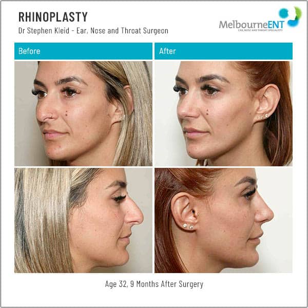 Age 32, 9 Months after Surgery Age 32, 9 Months after Surgery