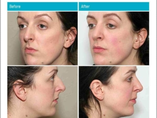 Age 33, 9 Months After Surgery Age 33, 9 Months After Surgery