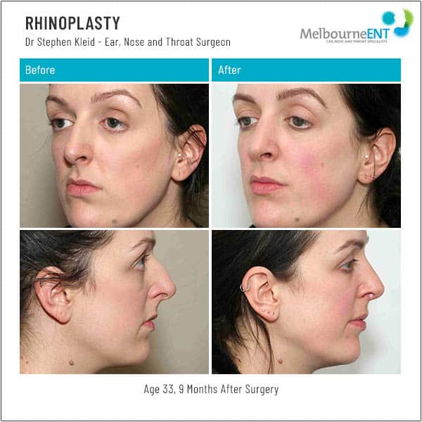 Age 33, 9 Months After Surgery Age 33, 9 Months After Surgery