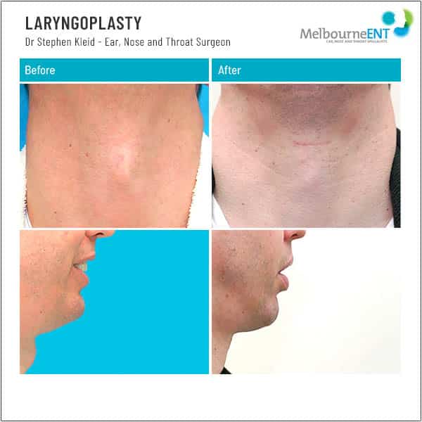 LARYNGOPLASTY Patient 1 LARYNGOPLASTY Patient 1