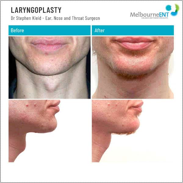 LARYNGOPLASTY Patient 2 LARYNGOPLASTY Patient 2