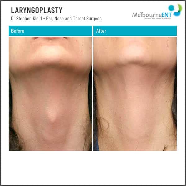 LARYNGOPLASTY Patient 3 LARYNGOPLASTY Patient 3