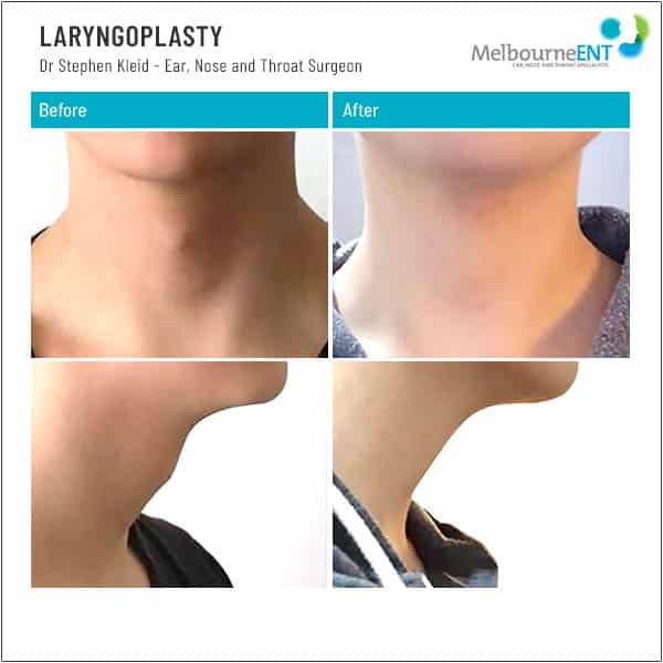 LARYNGOPLASTY Patient 4 LARYNGOPLASTY Patient 4