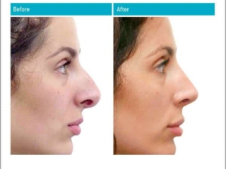 Before and After Rhinoplasty Before and After Rhinoplasty