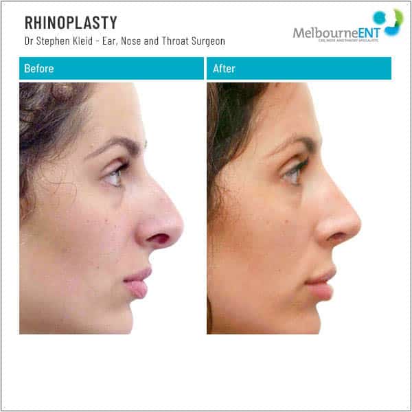 Before and After Rhinoplasty Before and After Rhinoplasty
