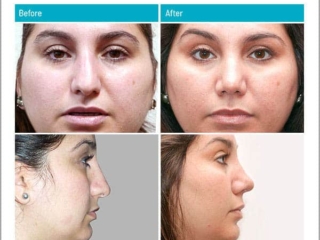 Reduction of projection Reduction of projection