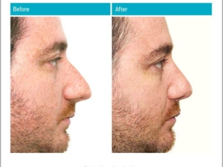 Reduction of Projection Reduction of Projection