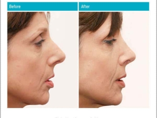 Reduction of over projection Reduction of over projection