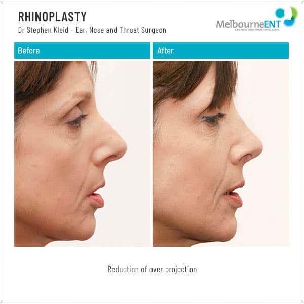 Reduction of over projection Reduction of over projection