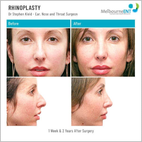 1 week and 2 Years After Surgery 1 week and 2 Years After Surgery