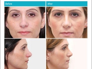 Complex Revision Rhinoplasty Complex Revision Rhinoplasty