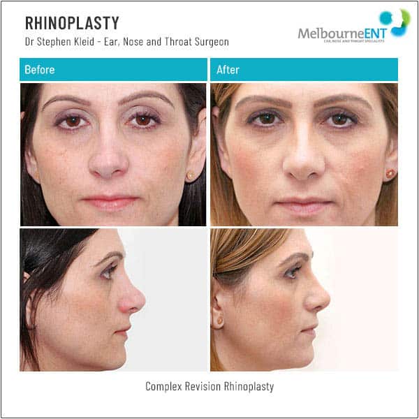 Complex Revision Rhinoplasty Complex Revision Rhinoplasty