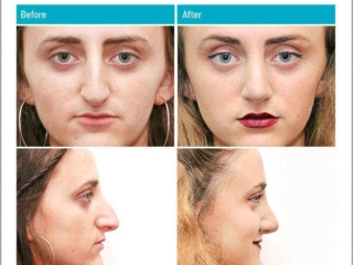 Major change in nasal shape, removing hump and elevating the lip Major change in nasal shape, removing hump and elevating the lip