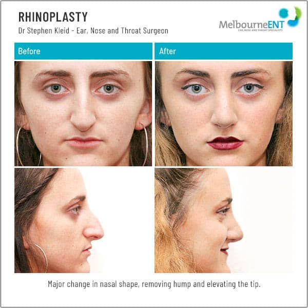 Major change in nasal shape, removing hump and elevating the lip Major change in nasal shape, removing hump and elevating the lip