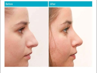 Before and After Rhinoplasty Before and After Rhinoplasty