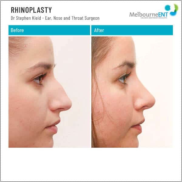 Before and After Rhinoplasty Before and After Rhinoplasty