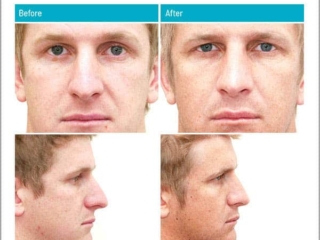 Male Before and After Rhinoplasty Male Before and After Rhinoplasty