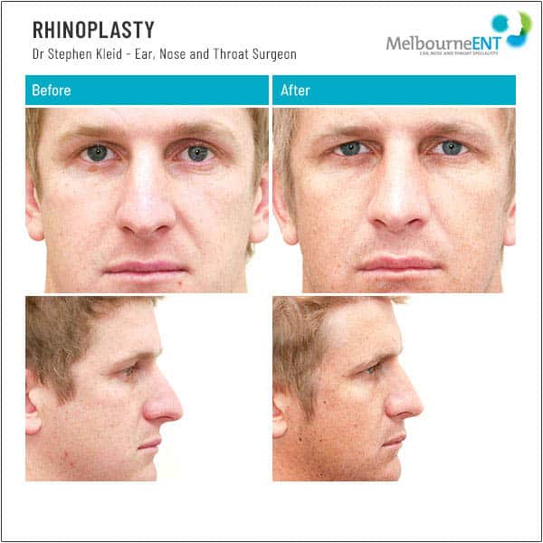 Male Before and After Rhinoplasty Male Before and After Rhinoplasty