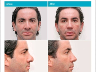 Revision of Polly-beak deformity Revision of Polly-beak deformity