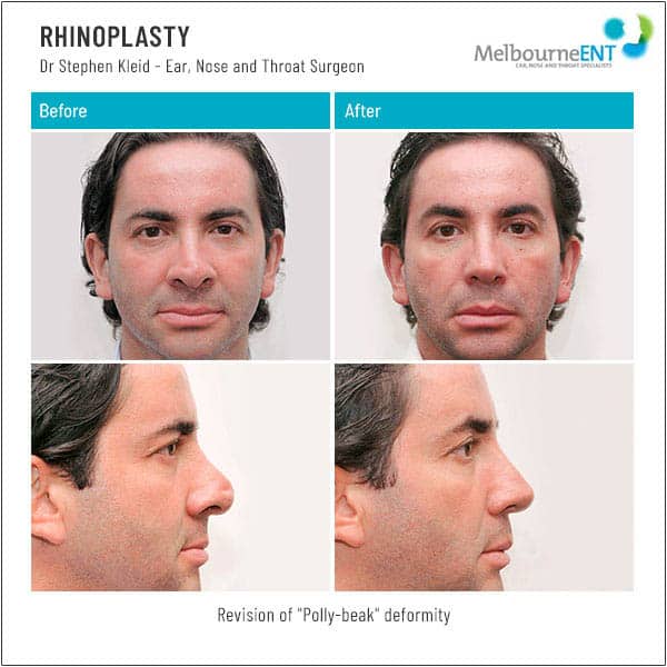 Revision of Polly-beak deformity Revision of Polly-beak deformity