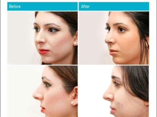 Correction of excessive projection Correction of excessive projection