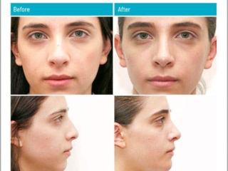 Combination of a rhinoplasty and chin modification