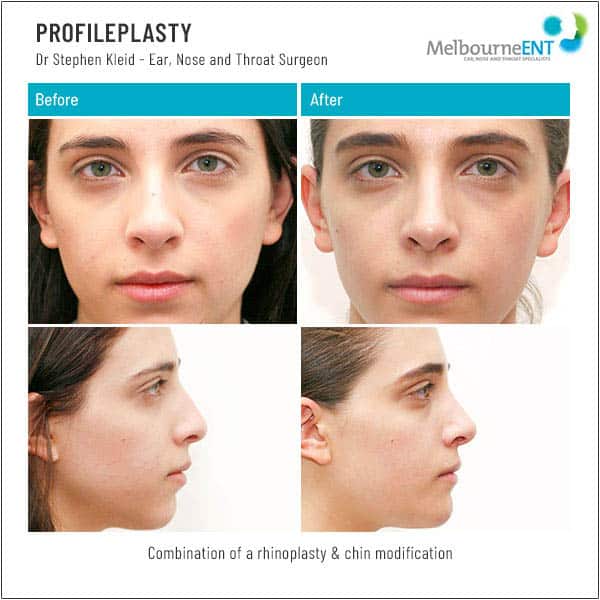 Combination of a rhinoplasty and chin modification