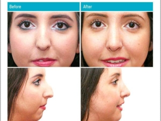 Combination of a rhinoplasty and chin modification Combination of a rhinoplasty and chin modification