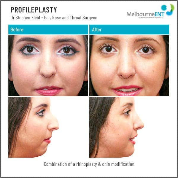 Combination of a rhinoplasty and chin modification Combination of a rhinoplasty and chin modification