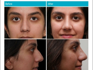 18 to 24 year old woman treated with open rhinoplasty 18 to 24 year old woman treated with open rhinoplasty