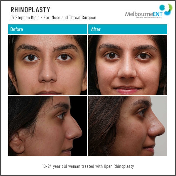 18 to 24 year old woman treated with open rhinoplasty 18 to 24 year old woman treated with open rhinoplasty
