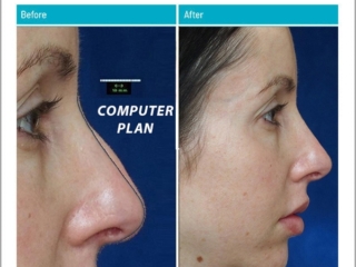 Good natural-looking nose at 2 years post-op, similar to her pre-operative computer plan Good natural-looking nose at 2 years post-op, similar to her pre-operative computer plan