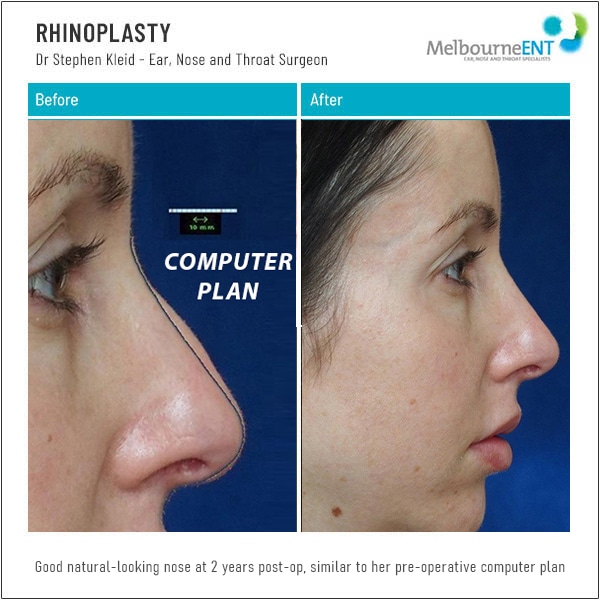 Good natural-looking nose at 2 years post-op, similar to her pre-operative computer plan Good natural-looking nose at 2 years post-op, similar to her pre-operative computer plan