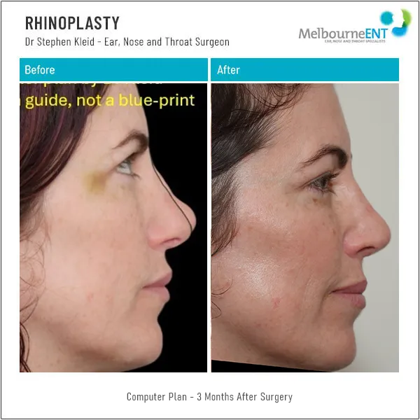 Rhinoplasty 3 Months After Surgery Computer Plan Before and After Rhinoplasty 3 Months After Surgery Computer Plan Before and After