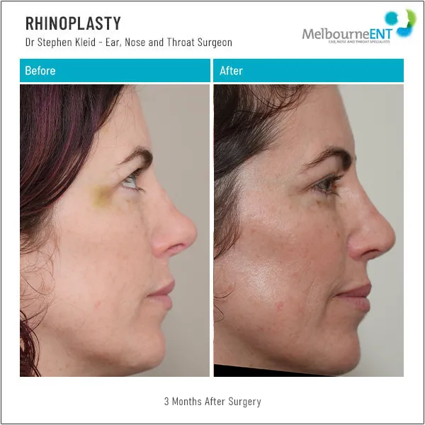 Rhinoplasty 3 Months After Surgery Before and After Rhinoplasty 3 Months After Surgery Before and After