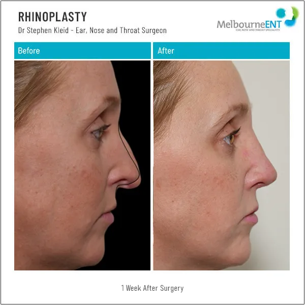 Rhinoplasty 1 Week After Surgery Before and After Rhinoplasty 1 Week After Surgery Before and After