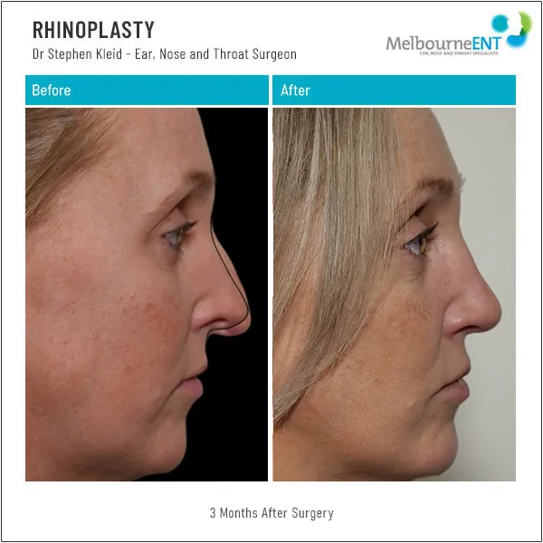 Rhinoplasty 3 Months After Surgery Before and After Rhinoplasty 3 Months After Surgery Before and After