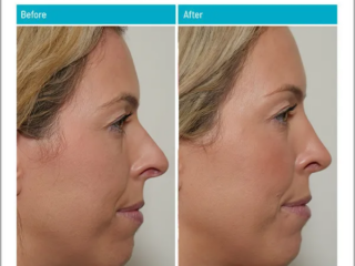 Before and After Rhinoplasty
