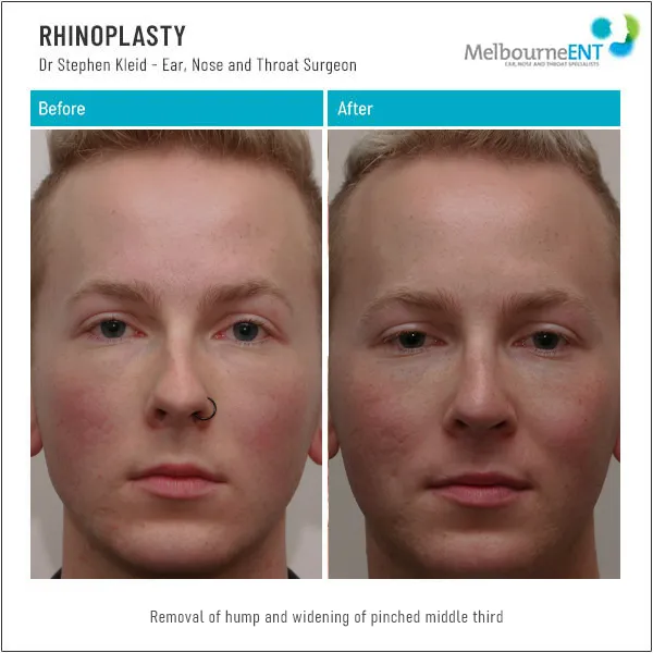 Rhinoplasty Hump Removal Side Before and After Rhinoplasty Hump Removal Side Before and After
