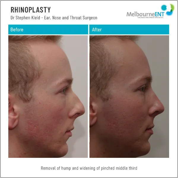 Rhinoplasty Hump Removal Side Before and After Rhinoplasty Hump Removal Side Before and After