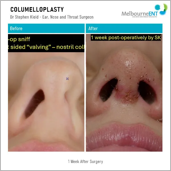 Columelloplasty Before and After Columelloplasty Patient 0001 Basal