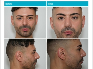 3 Months after surgery 3 Months after surgery