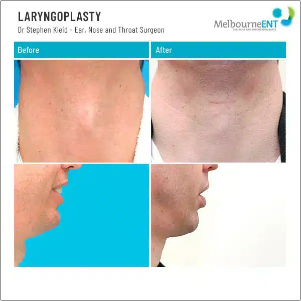 Laryngoplasty Before and After Laryngoplasty Before and After